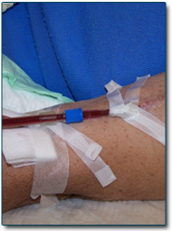 Dialyse péritonéale à domicile à Cambrai (59) Dialyse péritonéale à domicile à Cambrai (59)